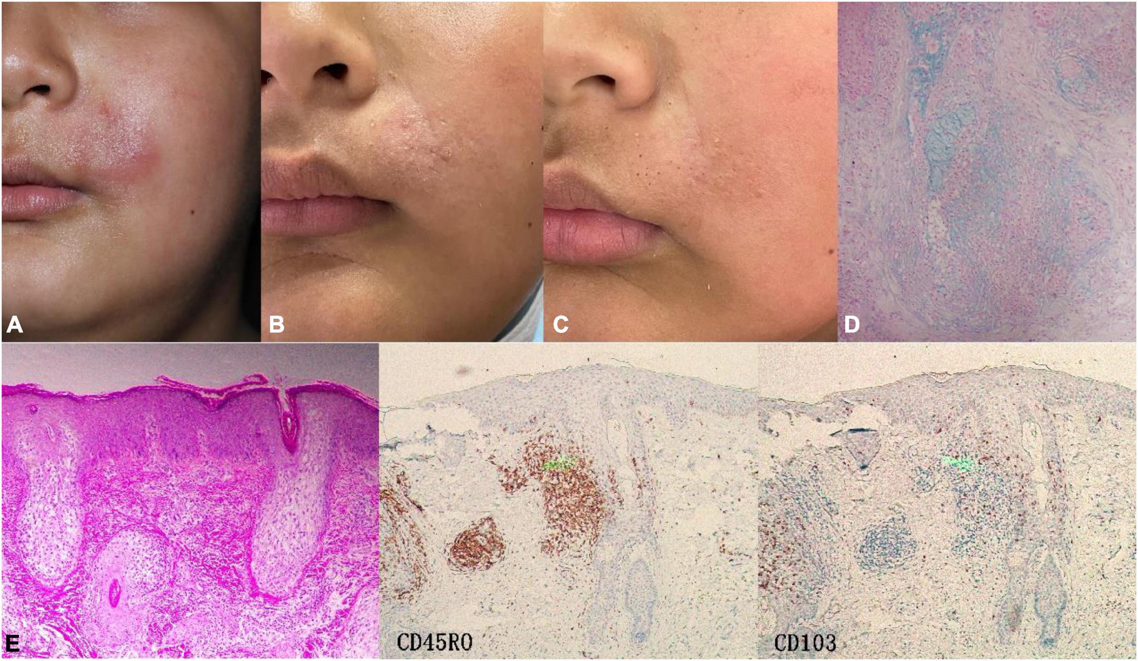 Clinicopathological features, therapeutic options, and significance of CD103 expression in 15 patients with follicular mucinosis